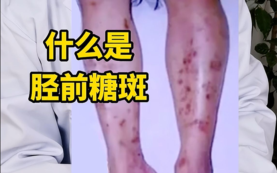 小腿上出现这种斑,预示糖尿病并发症出现吗?千万要提高警惕!