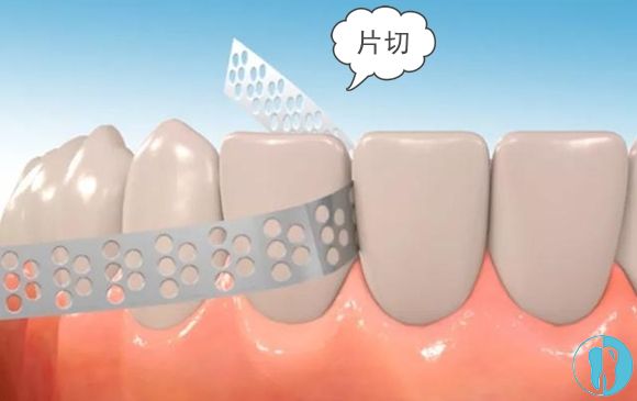 牙齿拥挤正畸一定要拔牙吗?