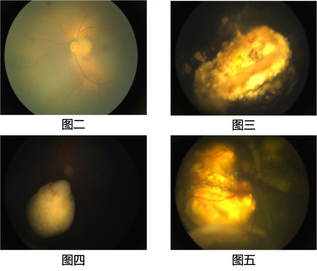 eales 病,一种特发性炎症性静脉闭塞性疾病,主要影响年轻人