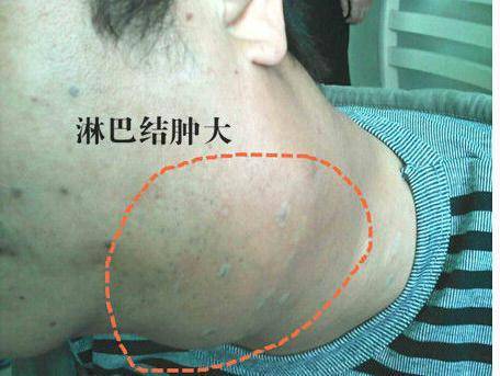 英国女子误将肿瘤认成皮肤病,耽误两年后已无法被治愈