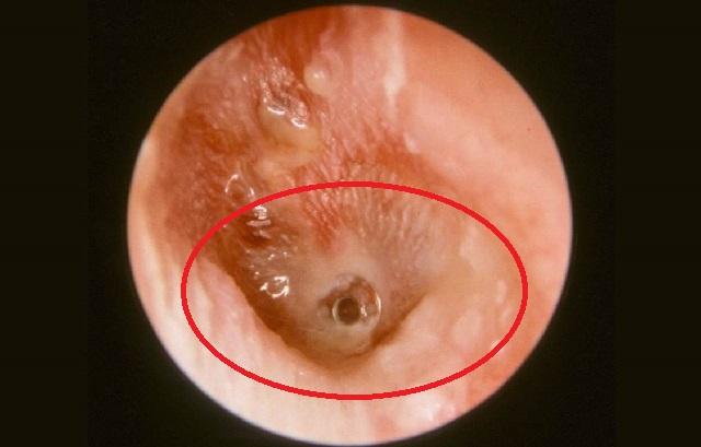 耳朵出现疼痛,流脓怎么回事?有可能是这个原因