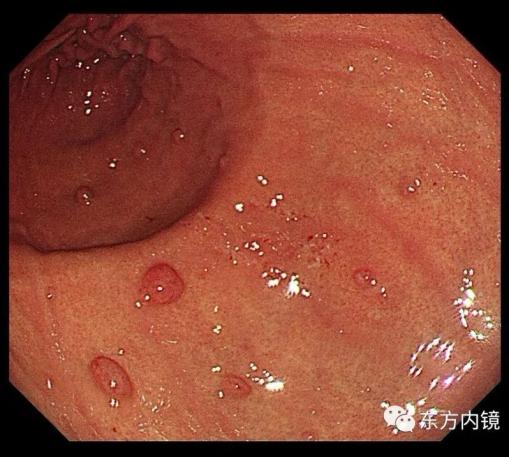 胃息肉和肠息肉一样容易癌变?