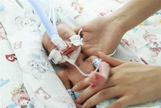 新生儿呼吸窘迫综合征,发病率低,致亡性高,诊治手段需了解