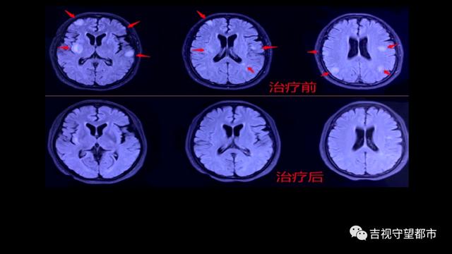 热点|女子一天吃一到两瓶辣酱还自行服胃药，两年半后大脑里“长毛”了