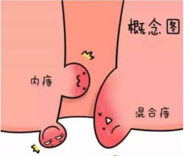 肛门外痔肉球怎么消除图片