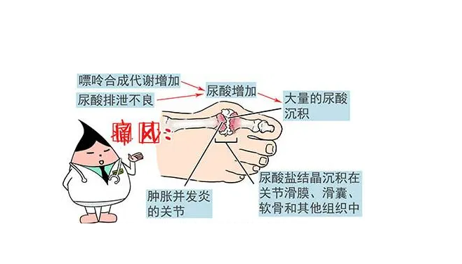 痛风不疼的时候是不是说明尿酸盐结晶溶解了?