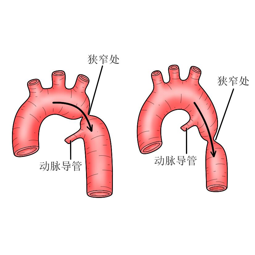 主动脉缩窄是以主动脉管腔狭窄为特征的心血管疾病,男性发病率高