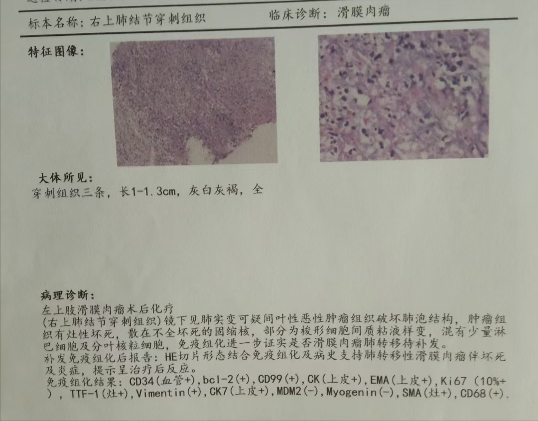 滑膜肉瘤发病率图片