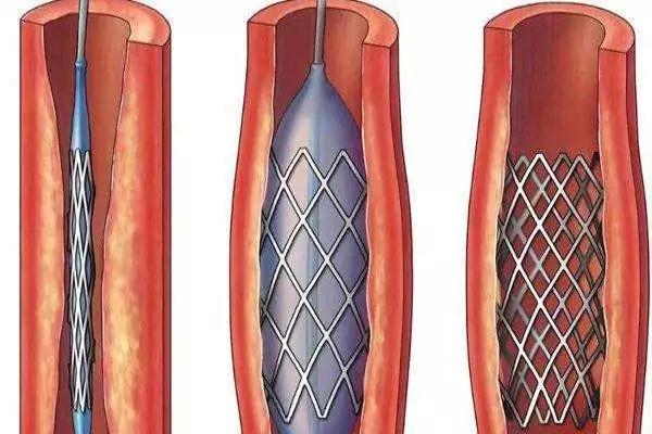 心脏支架多钱图片