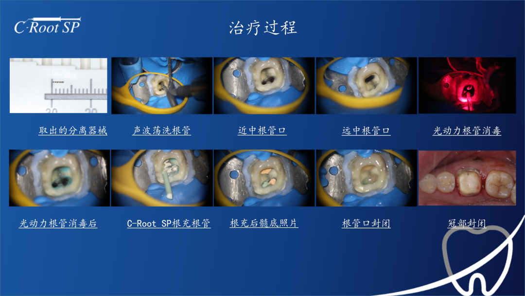 左下第一磨牙显微根管再治疗|喻刚医生使用c-root sp分享案例