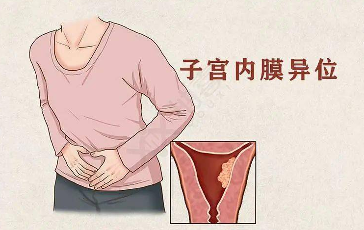 子宫内膜异位症会导致女性不孕?女性朋友们要警惕了!