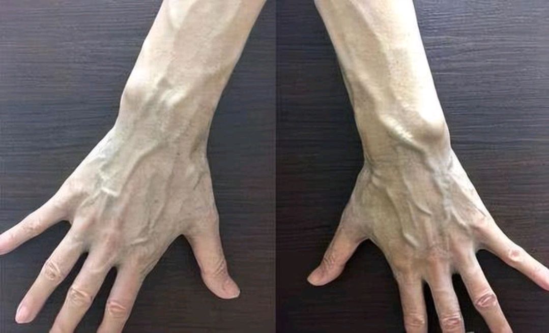 血管好不好,看手或许知道,多运动多喝水能改善血管动脉硬化吗?