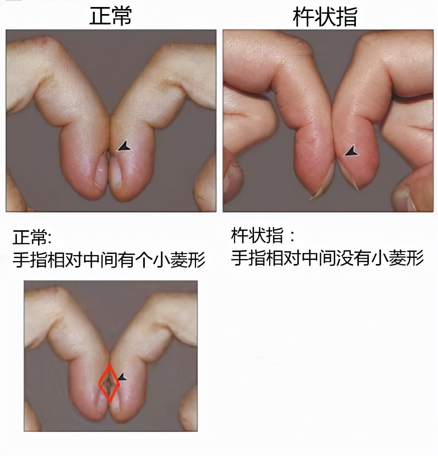 你的手指有这个特征吗?若符合,赶紧去做心电图