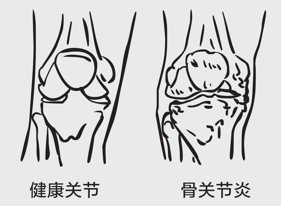 骨刺长在哪里图片图片