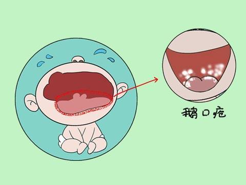 嘴里长了"白点"是怎么回事?除了口腔溃疡,还可能是哪种原因?