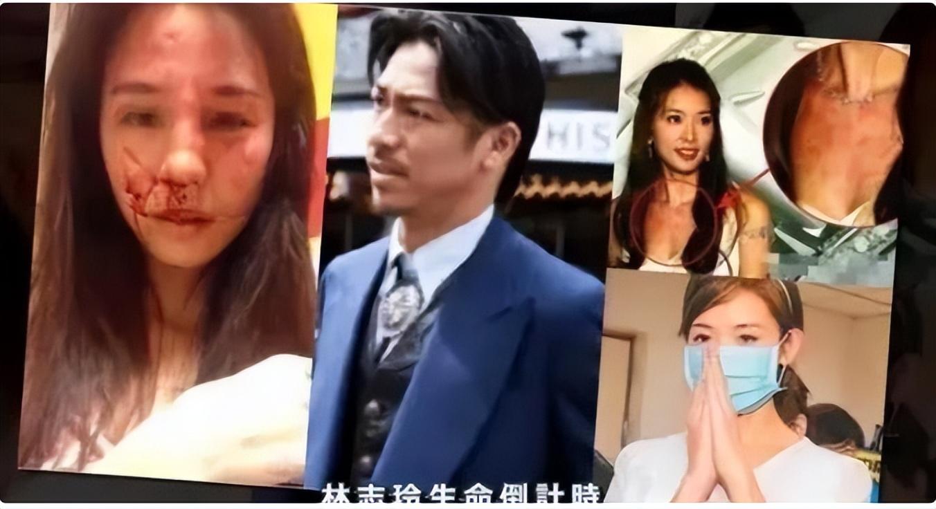 回顾林志玲被家暴流出疑似假体被打出回国修复日本老公出轨