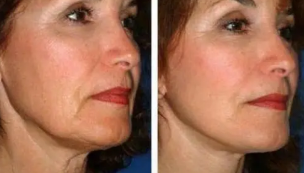 咨询医生:40岁拉皮能维持多久?脖子拉皮手术有危险吗?