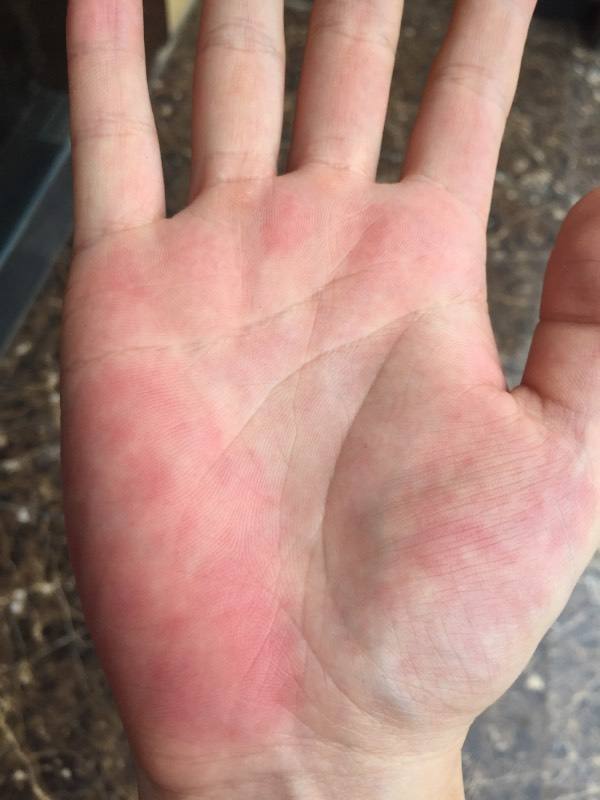 四川中医肿瘤专家吴晓玲:手掌变色危害大,手诊识别疾病!