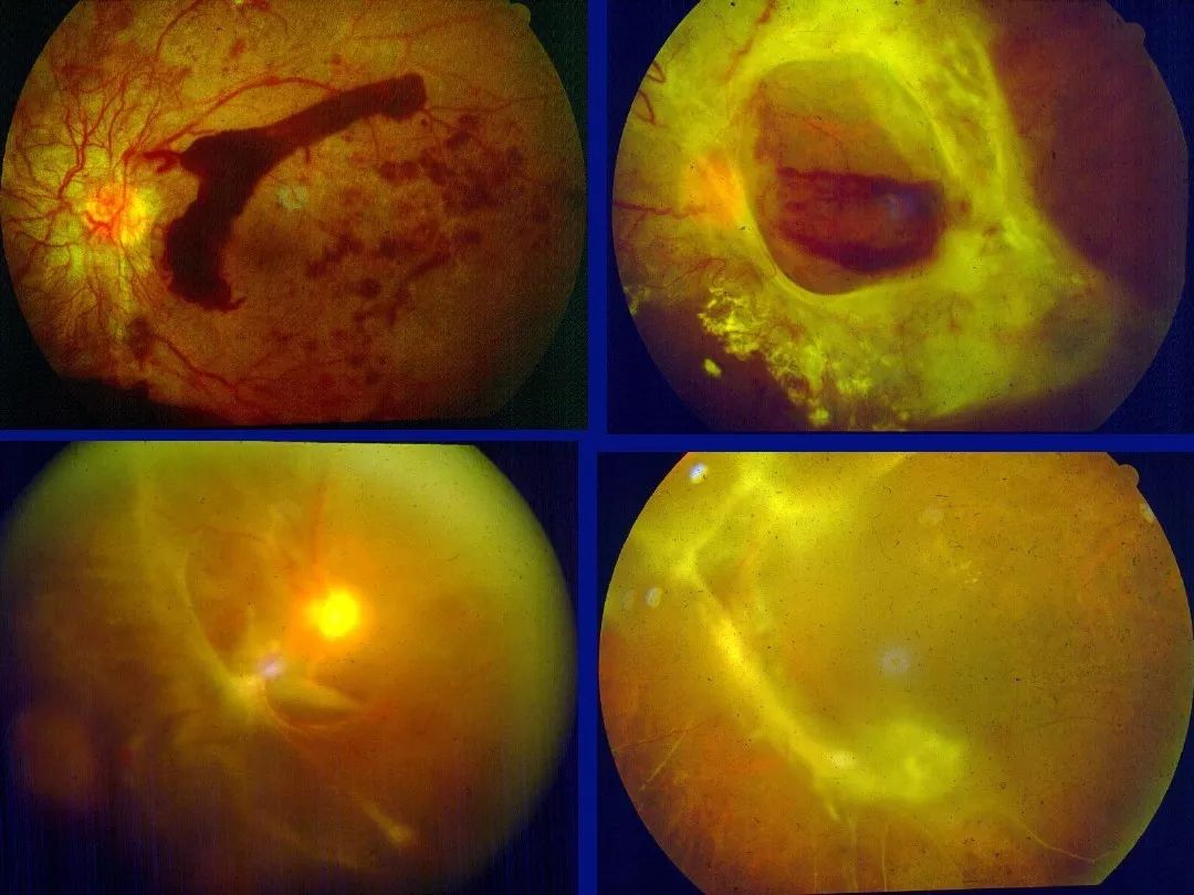 eales 病,一种特发性炎症性静脉闭塞性疾病,主要影响年轻人