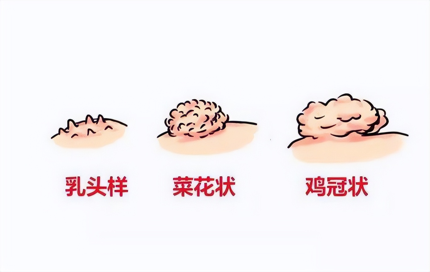 尖锐湿疣吃什么药能彻底治愈?