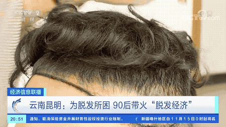 天悦登录中国已有2.5亿脱发人群 植发业市场规模已突破200亿