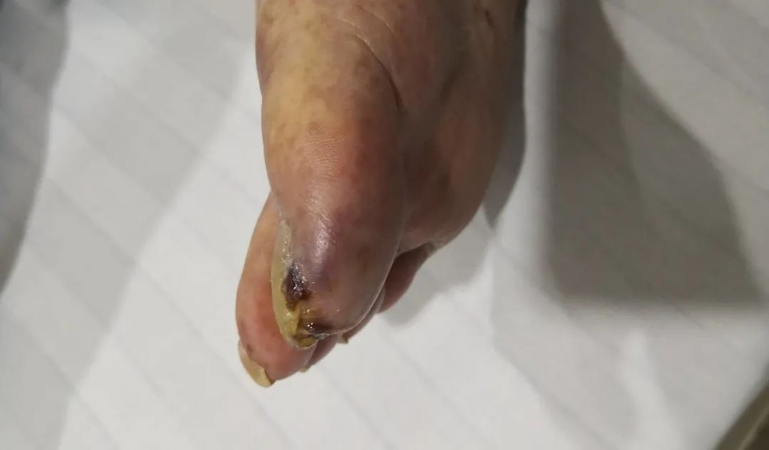 多少个夜里被 老烂脚 疼醒 这样的疾病该如何治疗 医院汇 丁香园