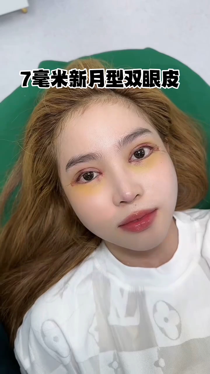 7mm新月型双眼皮