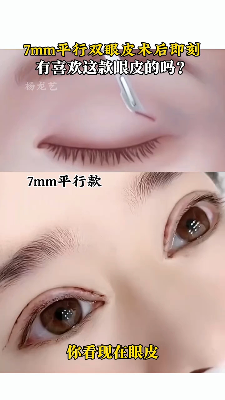 7mm平行双眼皮术后即刻