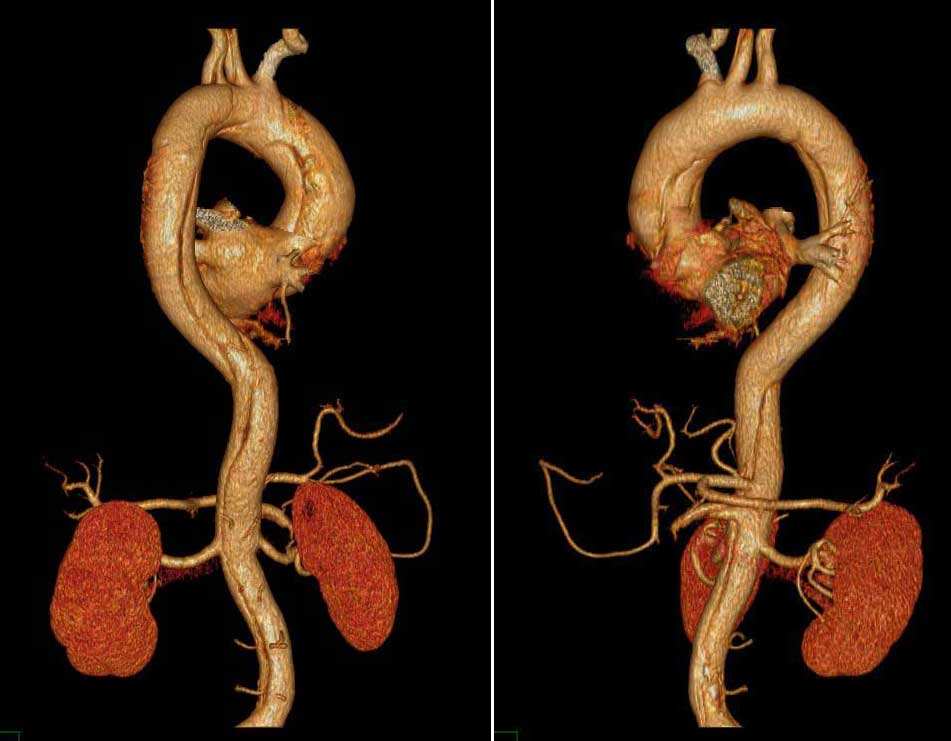 主动脉夹层血液进入主动脉壁,使各层分离,主动脉常见的突发疾病