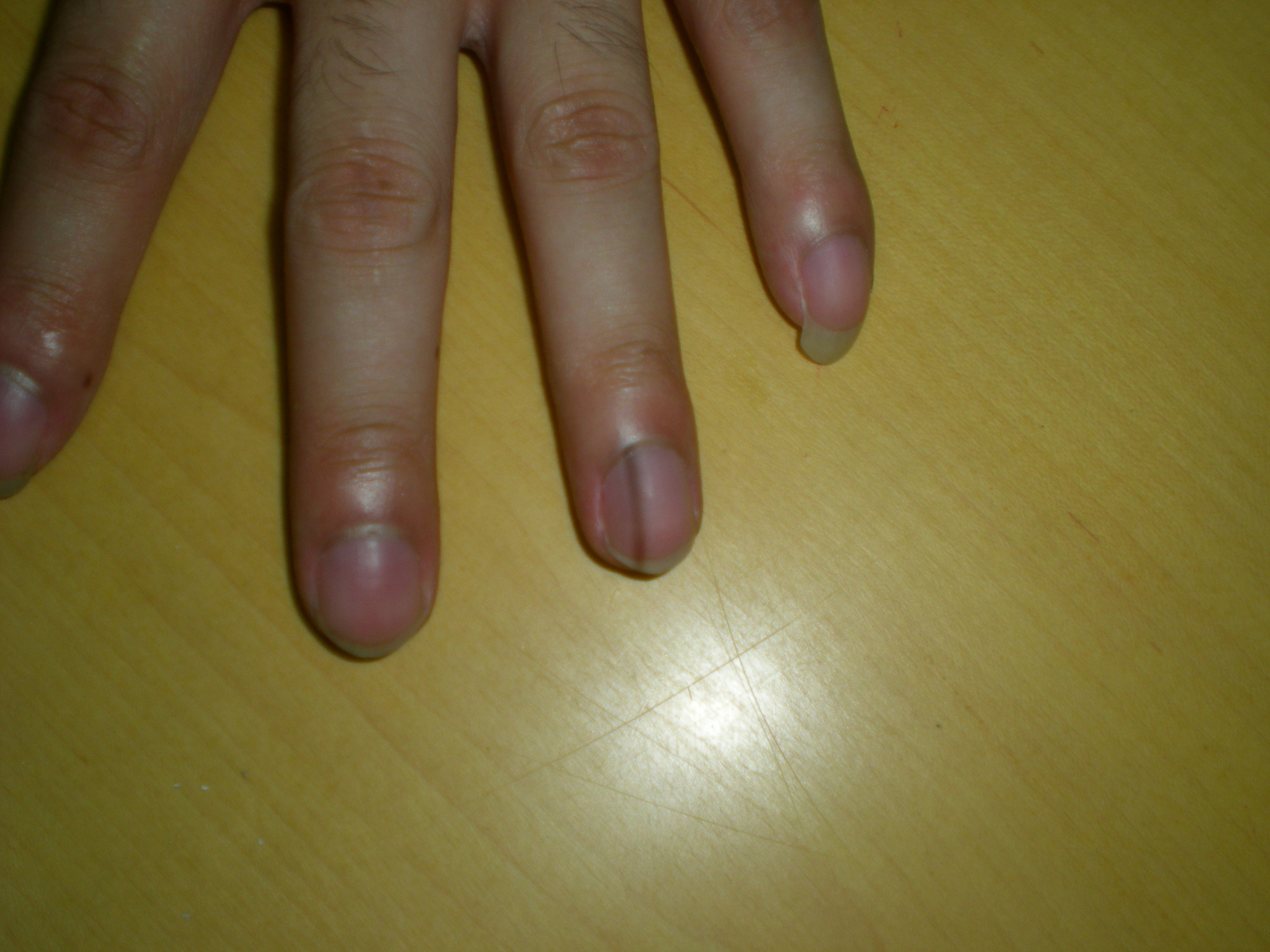 甲母痣患者建议及时就医,怀疑有恶变的,及时进行手术治疗