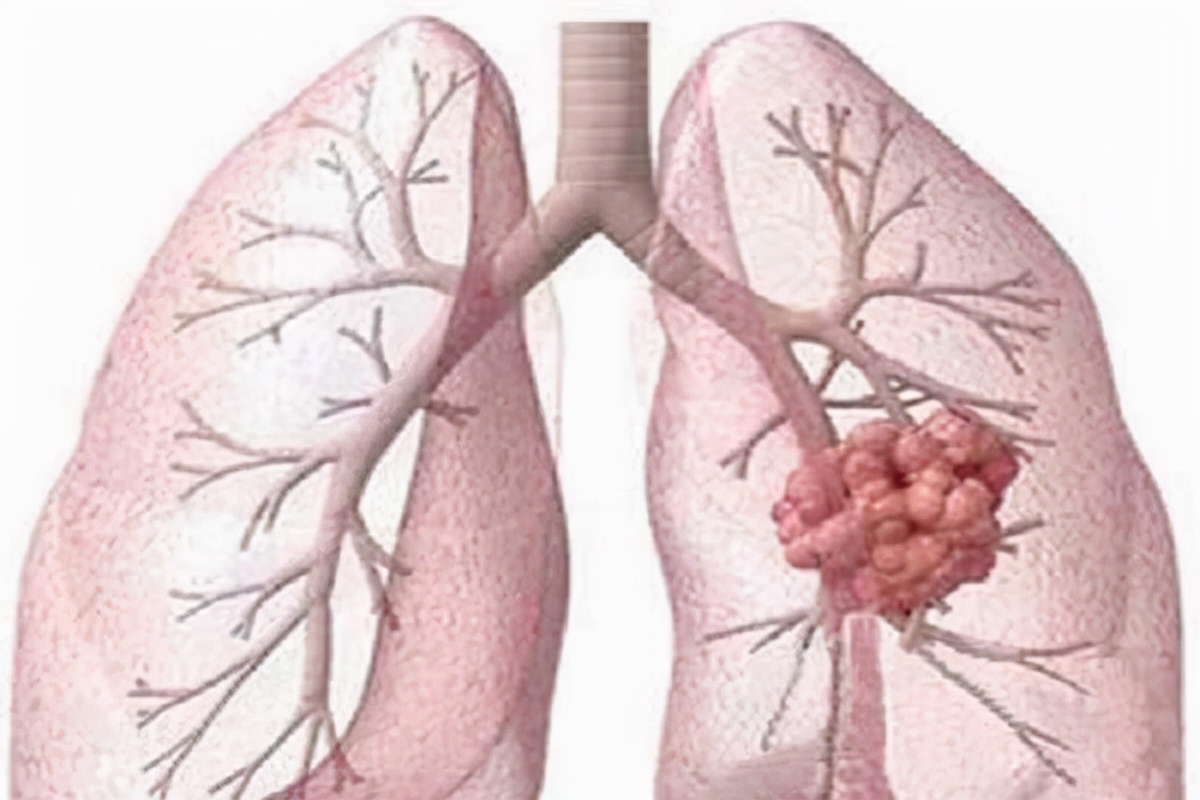 肺隐球菌病是隐球菌引起的肺部真菌感染,会传染,及时抗菌很重要