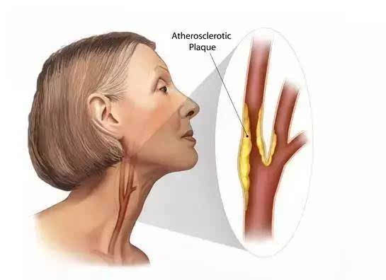 颈动脉堵塞,你知道受影响最大的部位是哪里吗?早知早受益