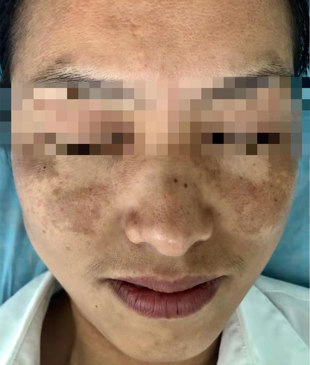 月经少,长斑?大多是肝肾阴虚!一个方子,疏肝补肾,养出好气色
