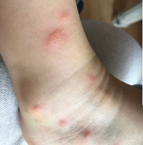 孩子被蚊子叮咬后奇痒无比!这几个实用方法消肿止痒,赶快收藏吧