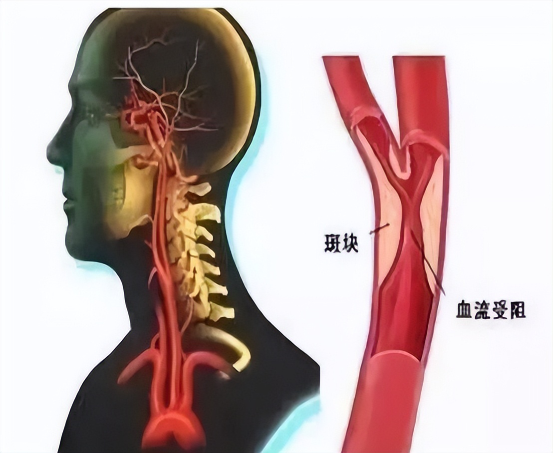 发现颈动脉斑块,就离脑梗不远了?做好3点,斑块或可变小