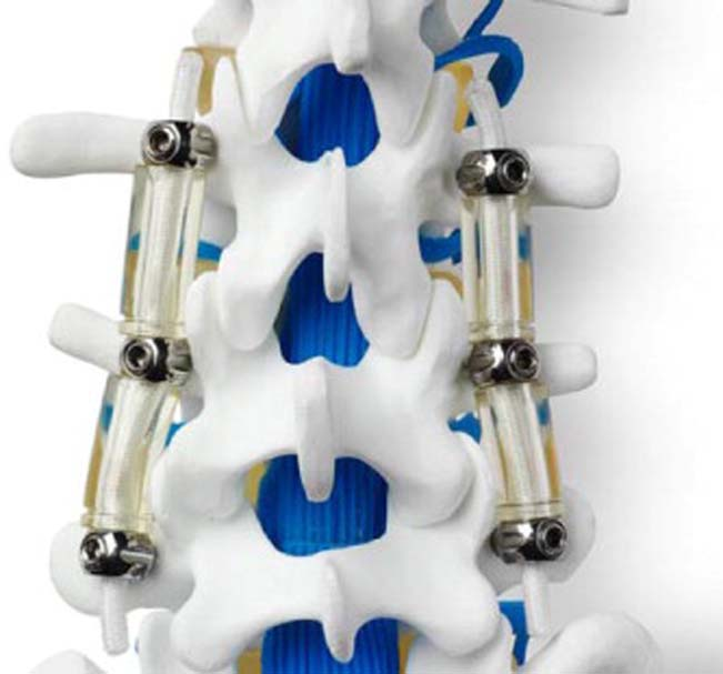 dynesys动态稳定系统,graf人工韧带graf人工韧带,isobar ttl