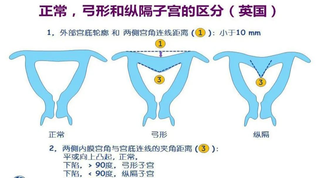 不全纵隔子宫y型图片图片