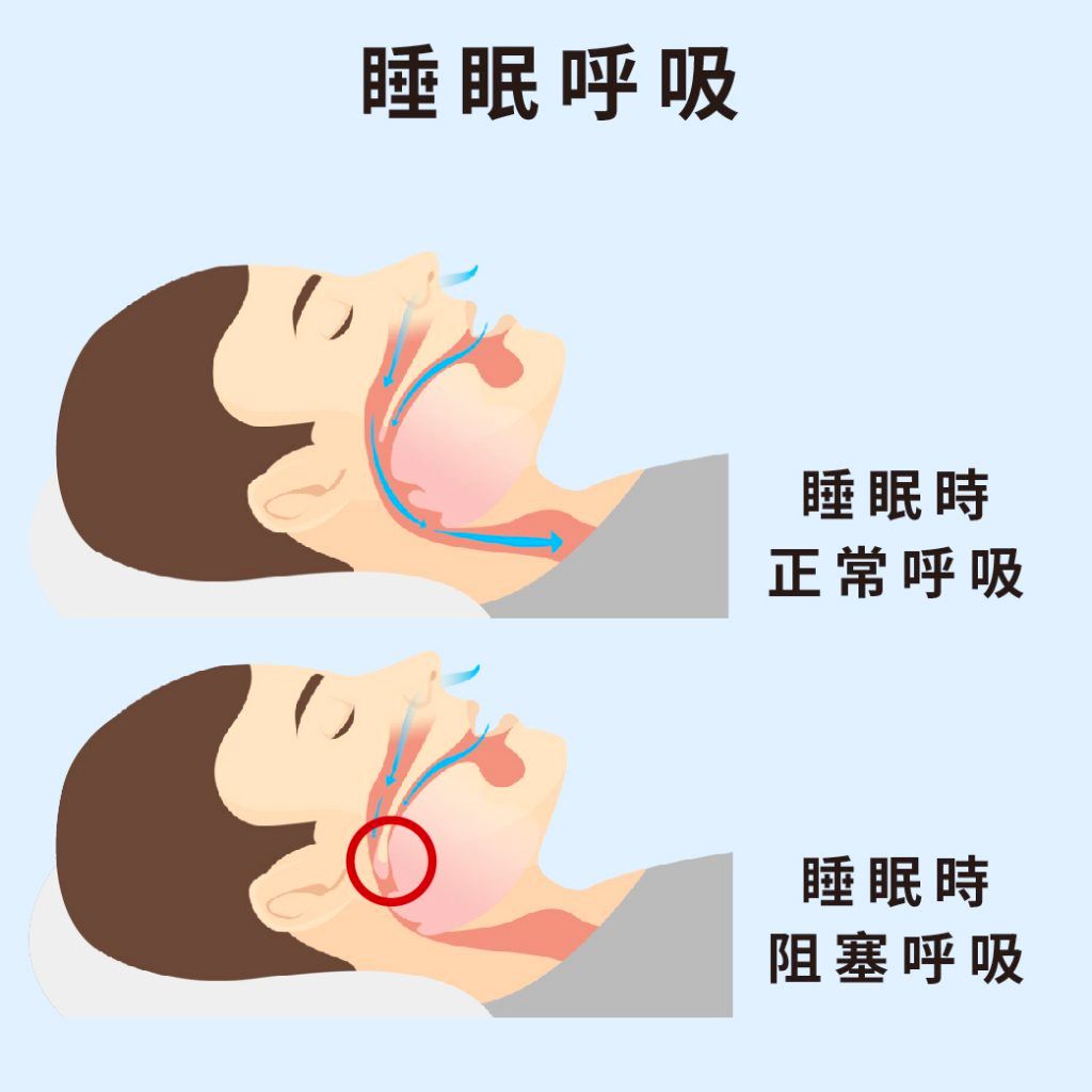 睡眠呼吸暂停综合症:睡眠障碍背后的呼吸问题