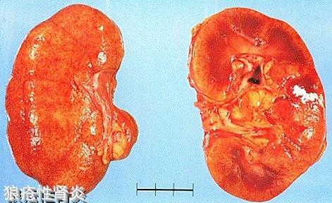 由系统性红斑狼疮引起的狼疮肾炎,人们是如何治疗这类疾病的?