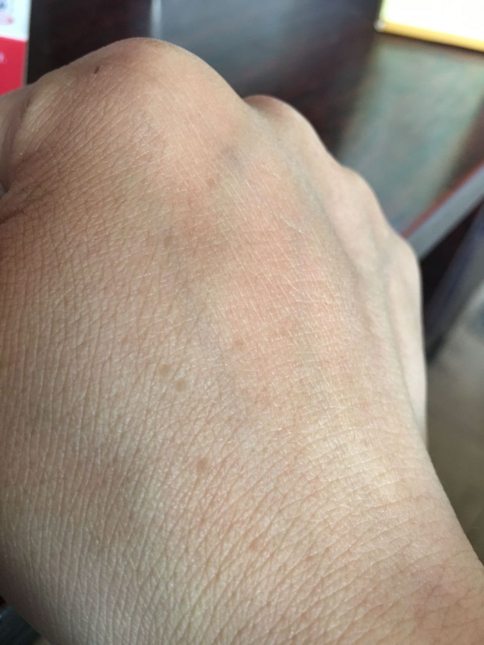 手上有老年斑消除最好的方法?