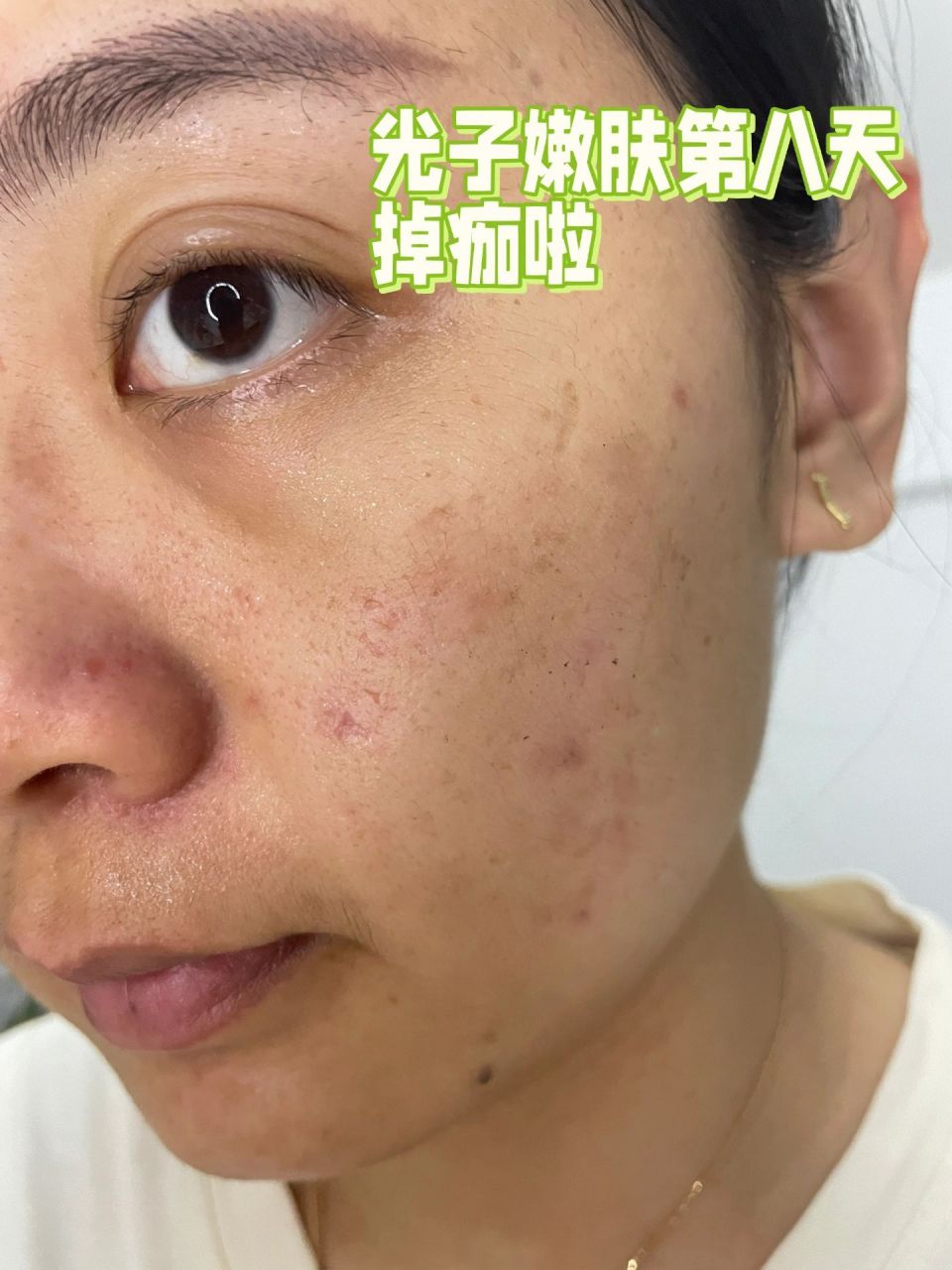 光子嫩肤一周后 结痂的地方已经基本脱落 以前左脸比较大块的色斑也淡