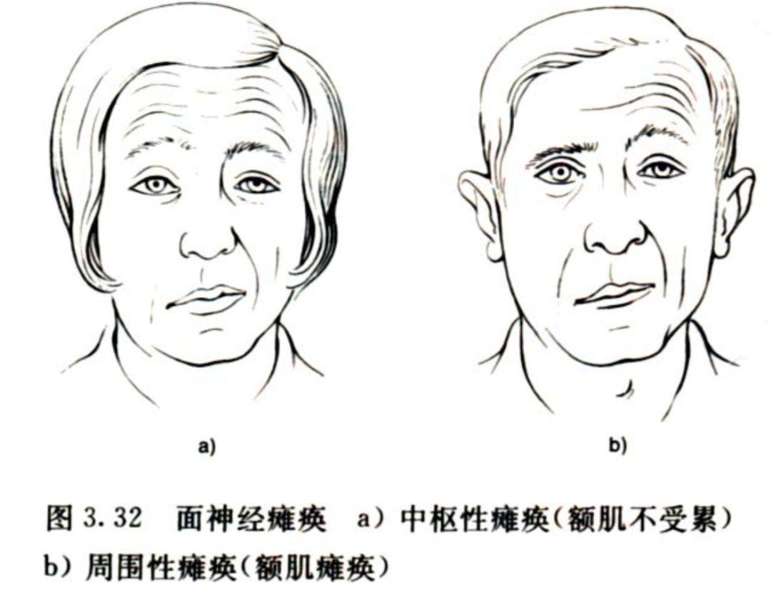 唇舌水肿-面瘫综合征发病原因不明,此病最常见于儿童或青少年