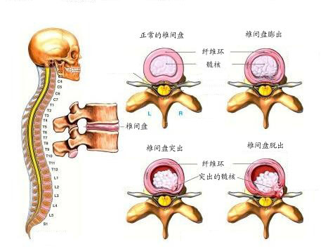 明明查出腰椎间盘突出,为啥会腿疼腿麻?