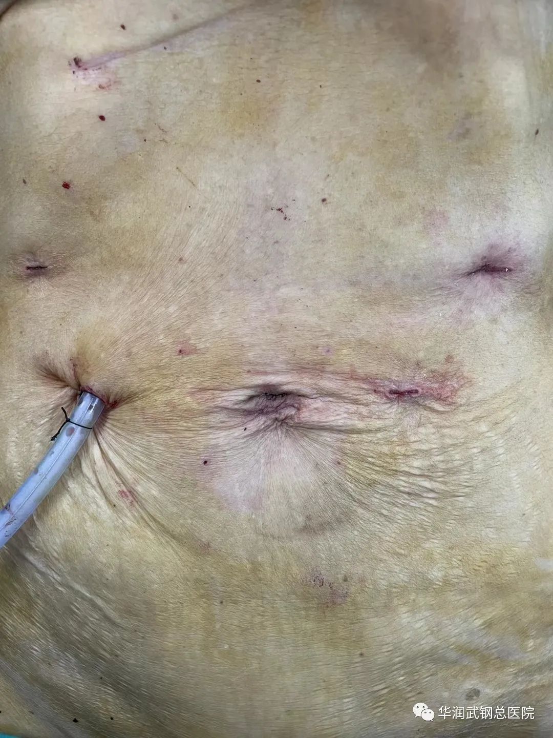 胃癌手术恢复刀疤图片图片