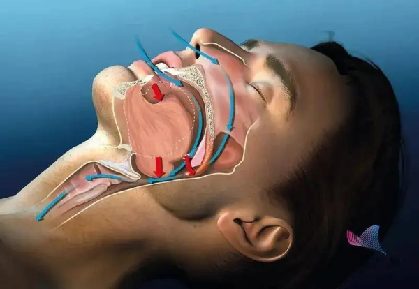杭州仁树医疗主任医师沈伟:睡觉打呼噜的人,你的生命质量正在流失
