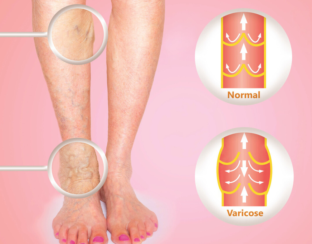 腿是血栓的"报警器"?提醒:这4种表现,提示血管可能堵塞了