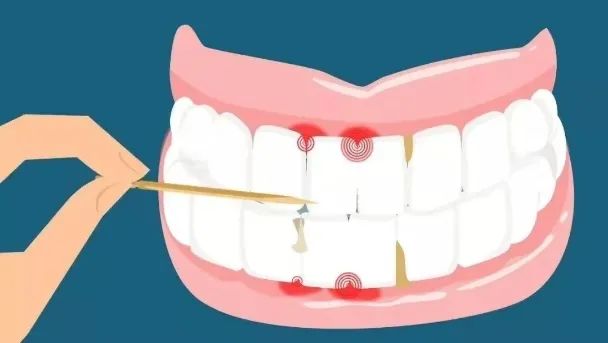 此后塞牙的次数越来越多 由于牙签坚硬,尖锐及体积较大,容易弄伤牙龈