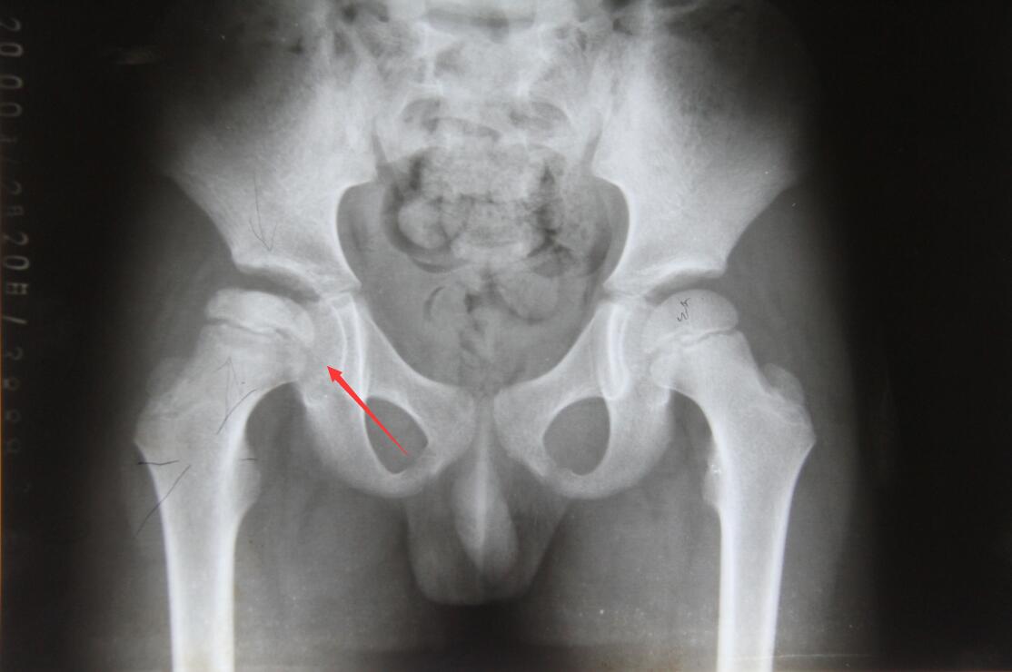 股骨解剖图x线图片