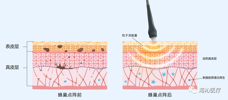 蜂巢皮秒的作用与功效图片