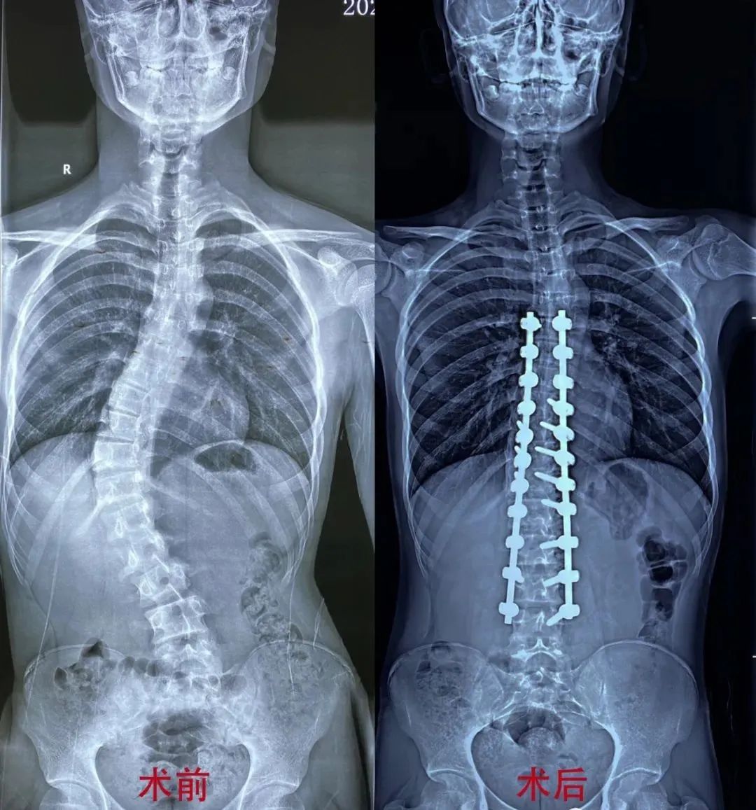 脊柱侧弯手术 利弊图片